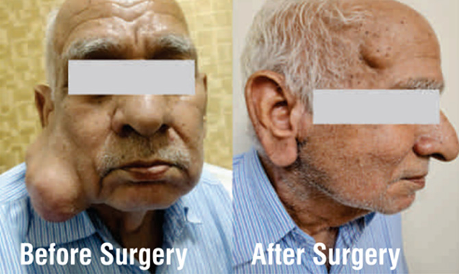 Very Large Face Tumor Operated Successfully at SSB Hospital, Faridabad
