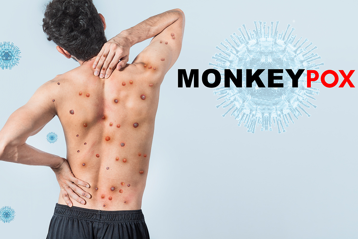 Monkeypox: What Are the Risk Factors and How Can You Protect Yourself?