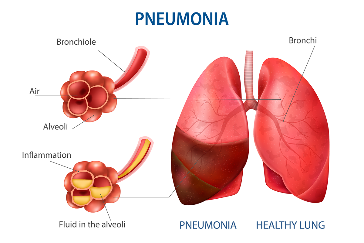 How to Win Against Pneumonia?