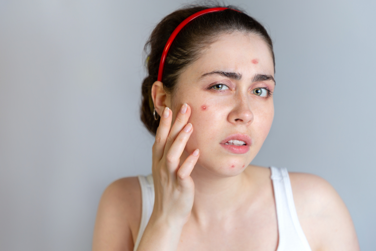 Acne: Causes, Symptoms & Prevention